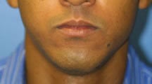Lip Surgery, Lip Reduction