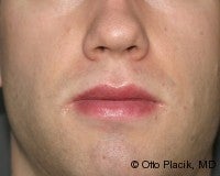Lip Reduction