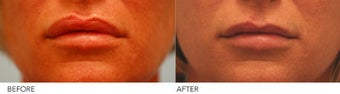 Lip reduction