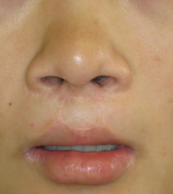 fati injection from abdomen to lip; dermabrasion to nostril scars