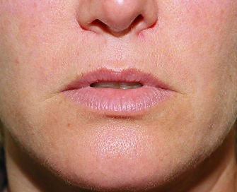 Lip lift, corner of lip lift, and filler in lips