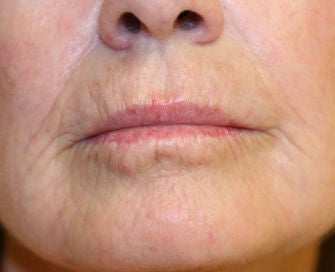 Lip lift, corner of lip lift, and laser treatment of wrinkles around lips