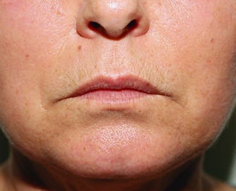 Anguloplasty