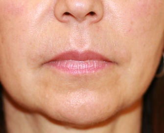 Anguloplasty