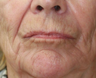 Lip lift, corner of lip lift, and filler around lips