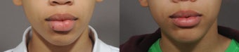 Lip Reduction