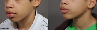 Lip Reduction