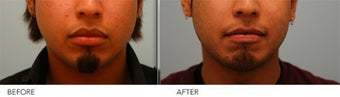 Upper and Lower Lip Reduction