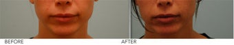 Upper Lip Reduction