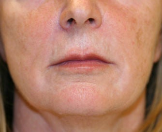 Lip Lift