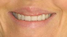 Lip Surgery, Lip Reduction