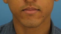 Lip Surgery, Lip Reduction