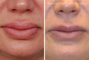 Lip Reduction and Repair