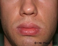 Lip Reduction