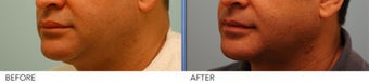 Male Upper Lip Reduction
