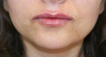 Lip Augmentation