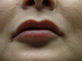 Lip Augmentation