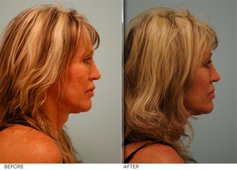 Lip Reduction for Correction of Silicone