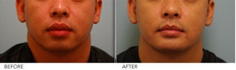 Lip Reduction for Correction of Silicone