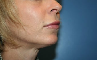 Lip Augmentation