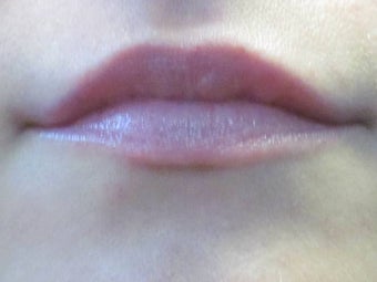 Lip Augmentation