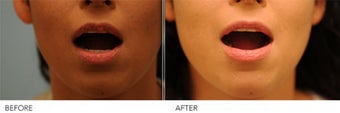 Upper Lip Reduction for Traumatic Lip Deformity