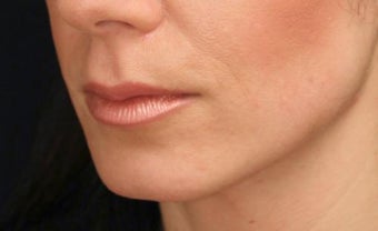 Lip augmentation