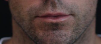 Male lip augmentation