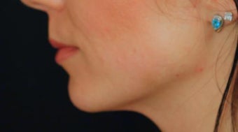 Lip Augmentation