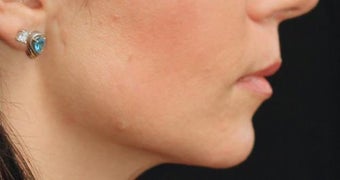 Lip Augmentation