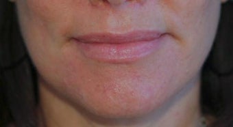 Lip Augmentation