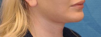 Lip Augmentation