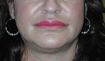 lip augmentation