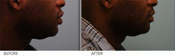 African American Lip Reduction