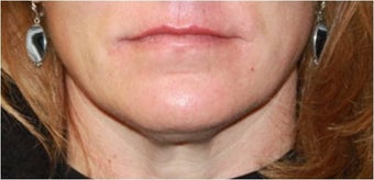 Lip augmentation - juvederm