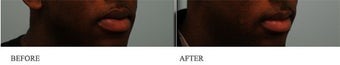 Upper and Lower Lip Reduction