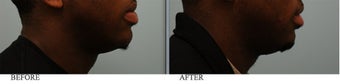 African American Lip Reduction