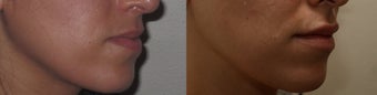 Lip Enhancement