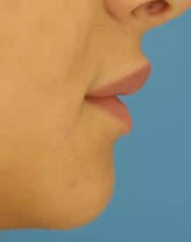 Lip Augmentation