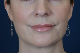 Lip Augmentation with Filler