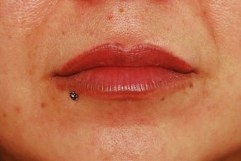 Lip Augmentation