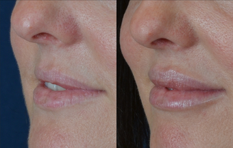 Lip Augmentation