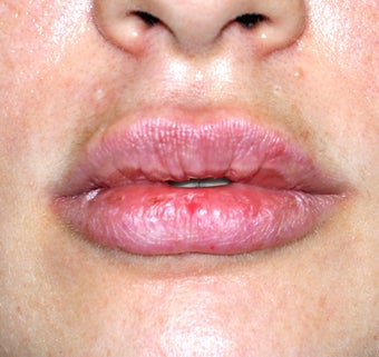 Lip Augmentation