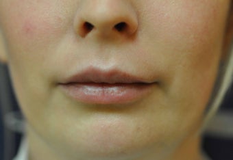 Lip Augmentation with Filler