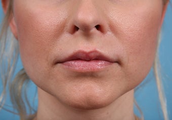 Lip Augmentation