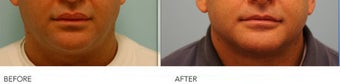 Male Upper Lip Reduction