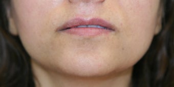 Lip Augmentation