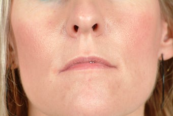Restylane