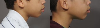 Lip Reduction