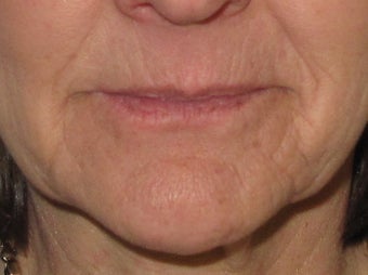 Lip Enhancement